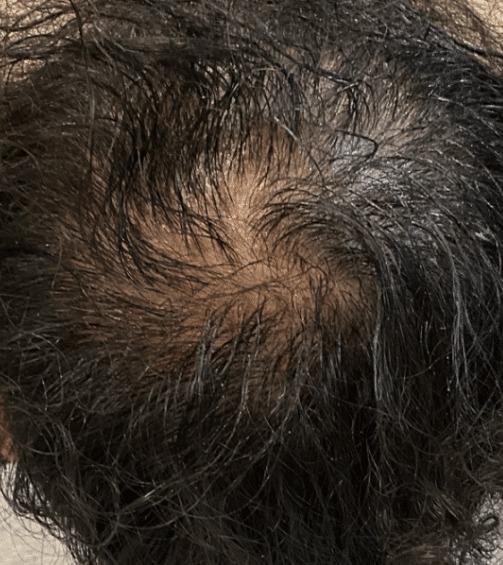 After Image: Patient # 4612 - front