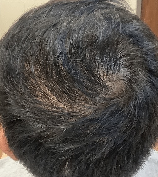 After Image: Patient # 4612 - 