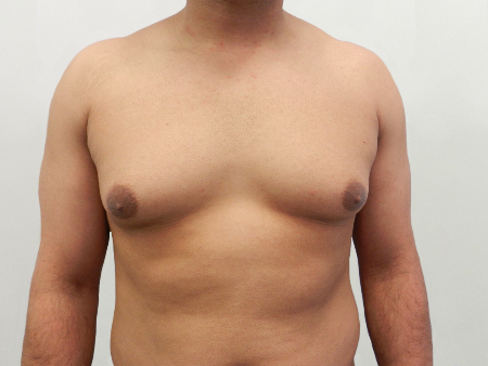 Before Image: Patient # 85461 - 