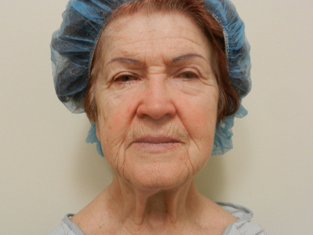 Before Image: Patient # 79225 - 