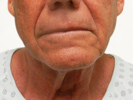 Before Image: Patient # 14086 - 