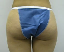 Before Image: Patient # 56076 - 