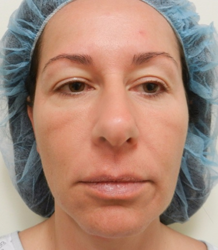 Before Image: Patient # 66548 - 