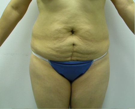 Before Image: Patient # 87805