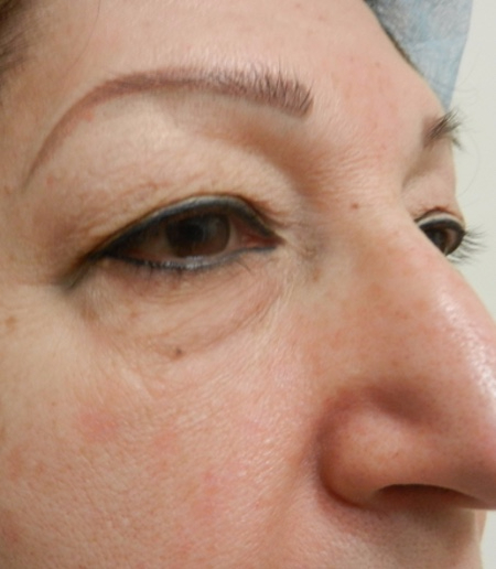 Before Image: Patient # 67366 - 