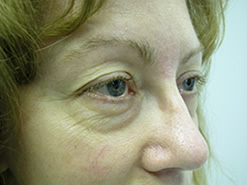 Before Image: Patient # 39324 - 