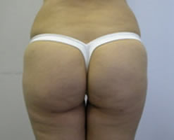 After Image: Patient # 49714 - 