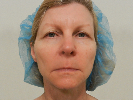 Before Image: Patient # 52315 - 
