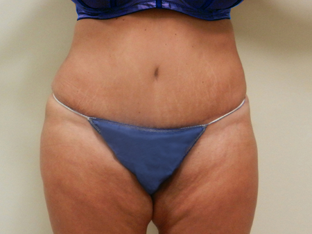 After Image: Patient # 75612 - 