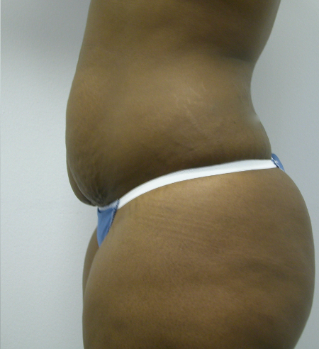 Before Image: Patient # 39176 - 