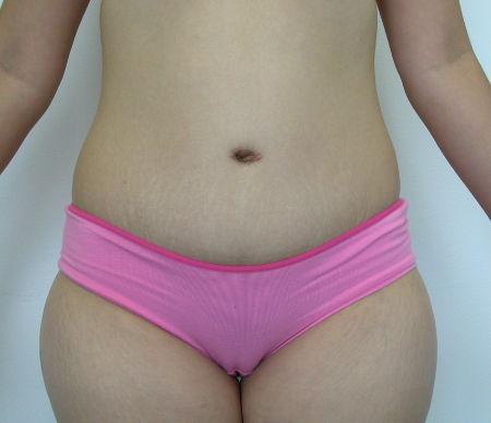 After Image: Patient # 29744 - 