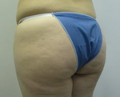 Before Image: Patient # 49714 - 