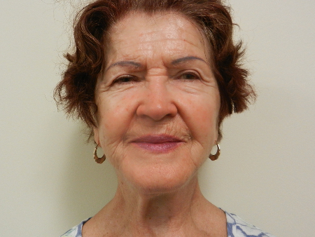 After Image: Patient # 79225 - 