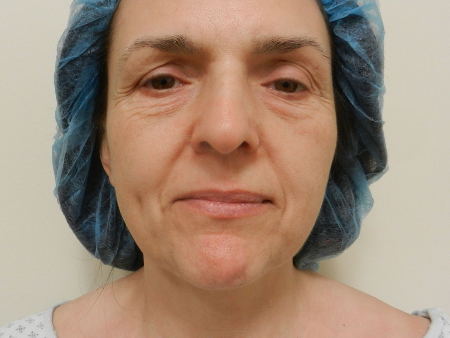 Before Image: Patient # 95309 - 