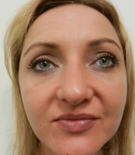 After Image: Patient # 32662 - 