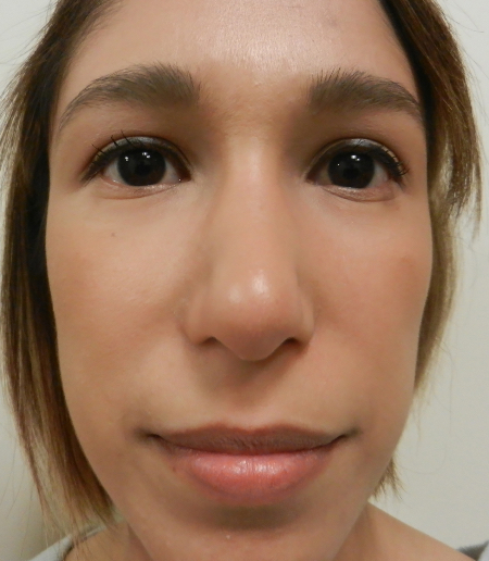 After Image: Patient # 71624 - 