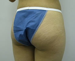 Before Image: Patient # 56076 - 