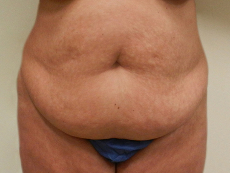 Before Image: Patient # 75612 - 