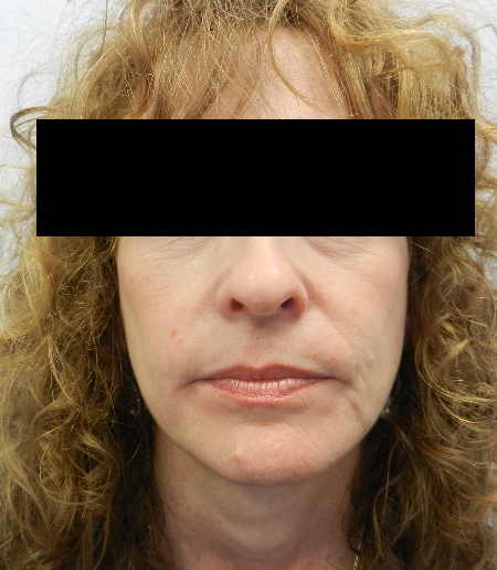 After Image: Patient # 41753 - 