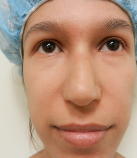 Before Image: Patient # 71624 - 