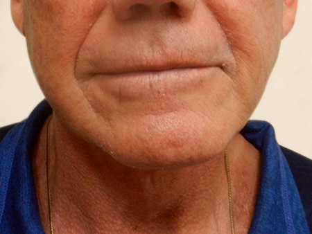 After Image: Patient # 14086 - 