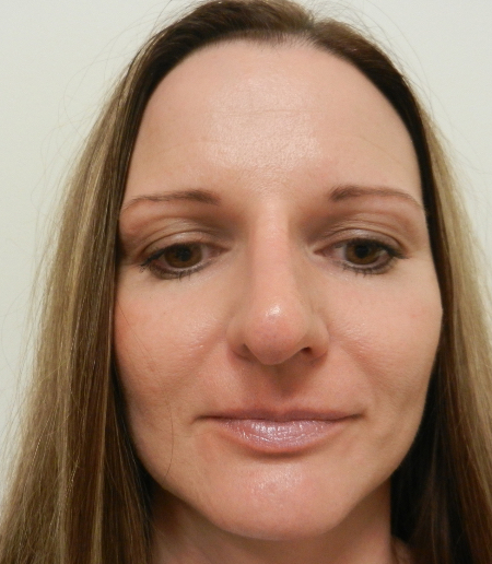 After Image: Patient # 36416 - 