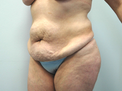 Before Image: Patient # 41580 - 
