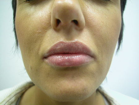 After Image: Patient # 86112 - 