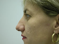 Before Image: Patient # 90921 - 