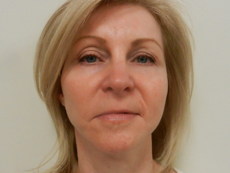 After Image: Patient # 52315 - 