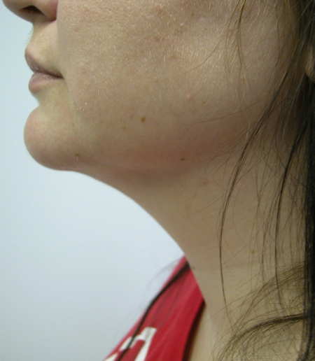 After Image: Patient # 32789 - 