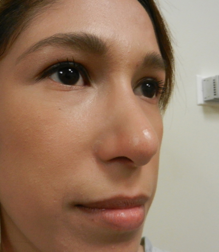 After Image: Patient # 71624 - 