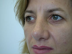 After Image: Patient # 90921 - 