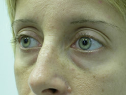 Before Image: Patient # 57571 - 