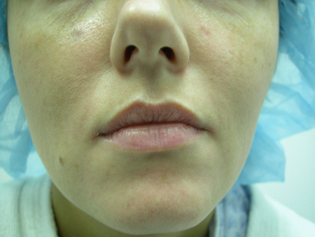 Before Image: Patient # 86112 - 