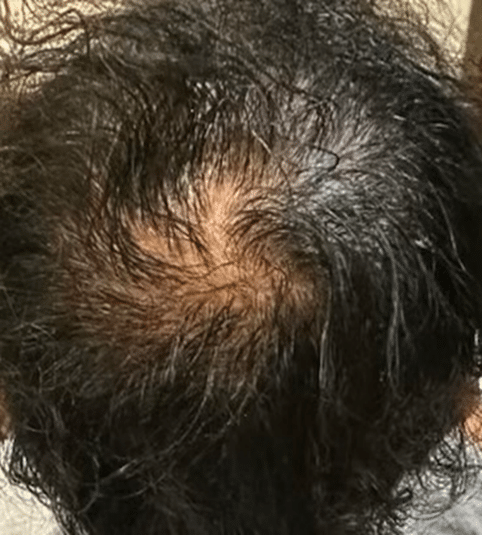 After Hair Restoration Chicago IL