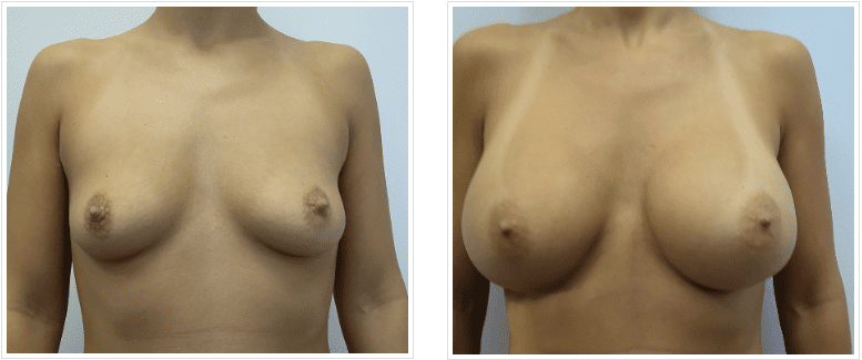 before and after Breast Implants Chicago IL